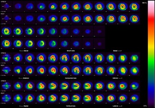 心筋シンチの撮影画像1