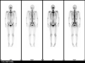 骨シンチの検査画像1