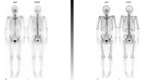 骨シンチの検査画像2
