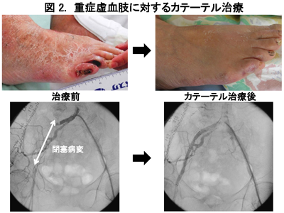 重症虚血肢に対するカテーテル治療前後の画像