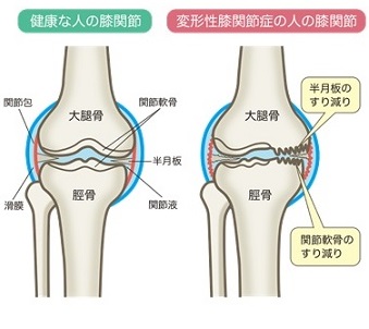 変形性膝関節症の画像