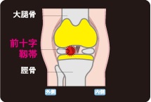 前十字靭帯損傷の画像