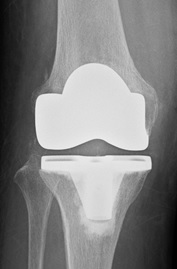 人工膝全置換術（TKA）のレントゲン画像