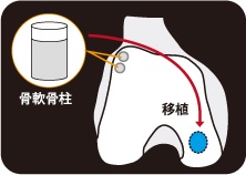 自家骨軟骨移植術の画像