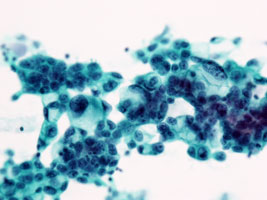 ​胃癌の細胞像（腺癌）の画像