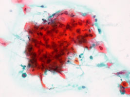 肺癌の細胞像（扁平上皮癌）の画像