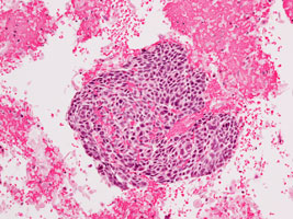 ​肺癌の組織像（扁平上皮癌）の画像