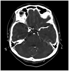 頭部CT-Angioの画像1