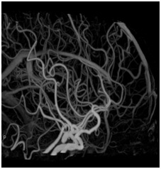 頭部CT-Angioの画像2