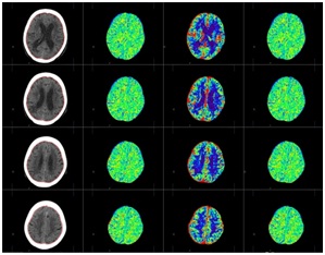 脳perfusion(CTP)の画像