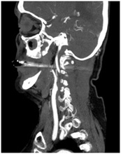 頸部CT-Angioの画像1