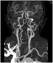 頸部CT-Angioの画像2