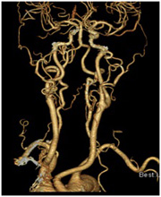頸部CT-Angioの画像3