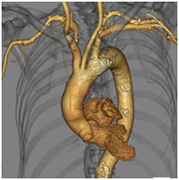 鎖骨下動脈CT-Angioの画像3