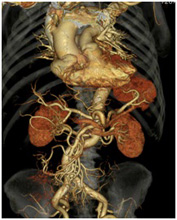 胸腹部大動脈の画像4