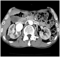 腎動脈CT-Angioの画像1