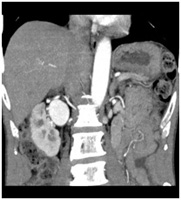 腎動脈CT-Angioの画像2