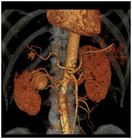 腎動脈CT-Angioの画像3
