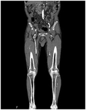 両下肢CT-Angioの画像1