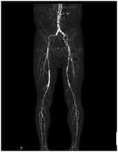両下肢CT-Angioの画像2
