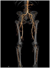 両下肢CT-Angioの画像3