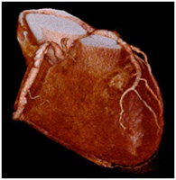心臓CT検査の画像2