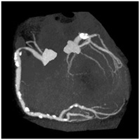 心臓CT検査の画像3