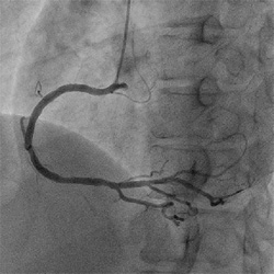 ​右冠動脈の画像