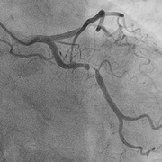 ​冠動脈形成術（PCI）治療前の画像