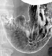 胃透視の画像