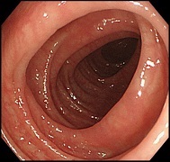大腸内視鏡の画像