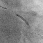 ​冠動脈形成術（PCI）治療中の画像