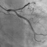 ​冠動脈形成術（PCI）治療後の画像